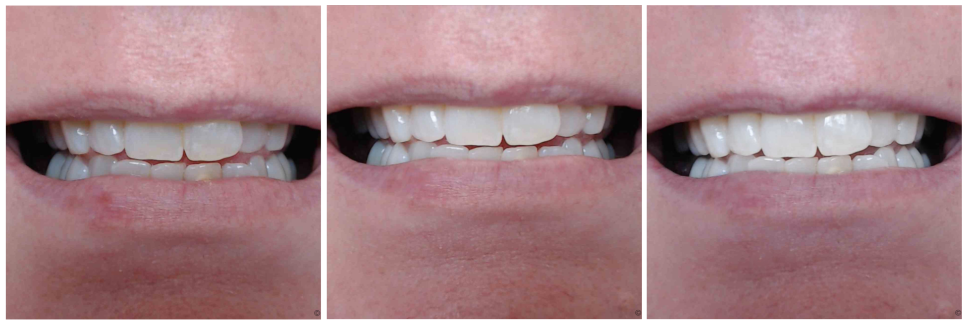 Whitening Strips Whiter Teeth In Just 14 Days Boxnip A UK Beauty amp Lifestyle Blog